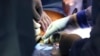 Boston Hospital Performs First Successful Pig Kidney Transplant to Human