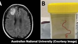 Un gusano de 8 centímetros ha sido encontrado vivo en el cerebro de una mujer en Australia.