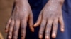 Magonjwa yaliyokuwa na athari kubwa Afrika 2024