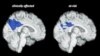 For Some, Mild Slips of Memory May Be Very Early Alzheimer's