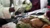 Terapi Antibiotik Tingkatkan Harapan Hidup Anak dengan Gizi Buruk