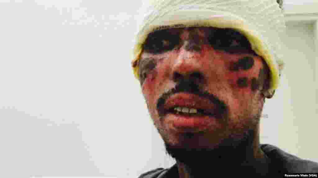 'Yan sumoga sun kona fuskar wannan mutumin a yayin da suke kokarin tsallakawa da shi zuwa Turai daga kasar Libya. VOA ta samu wannan hoton ne daga hannun wani dan kasar Italiya dake jinyar baki 'yan ci rani a birnin Milan a kasar Italiya.