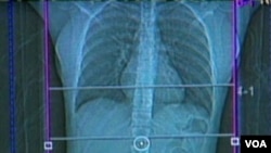 Los científicos llevan años alertando que el sobrepeso y la vida sedentaria elevan el riesgo de varios tipos de cáncer.