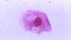 Experts Link Fatal Mystery Illness in Liberia to Meningitis Bacteria 