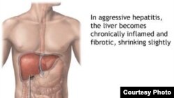 Hep B is the world’s most common liver infection. Photo courtesy of Adam.com