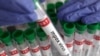 FILE P- A test tube labeled "Mpox virus positive" is held in this illustration taken Aug. 20, 2024. 