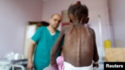 ARSIP - Seorang perawat mengamati seraya menimbang seorang anak yang mengalami gizi buruk dalam sebuah pusat perawatan malnutrisi di Sanaa, Yaman, 7 Oktober 2018 (foto: Reuters/Khaled Abdullah)