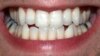 Survey: Poor Oral Health Among Olympians
