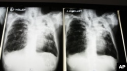 FILE - X-rays of a tuberculosis patient at A. G. Holley Hospital in Lantana, Florida.