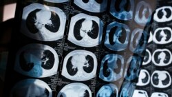 Quiz - Researchers Say AI System Greatly Improves Lung Cancer Predictions