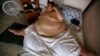Study: Extreme Obesity Cuts 14 Years Off Life 