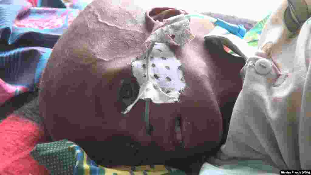 Le regard vide, cet enfant de deux ans présente une forme aiguë de malnutrition. Il ne pèse que 5,6 kilos, Diffa, Niger, le 18 avril 2017 (VOA/Nicolas Pinault)