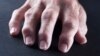 Scientists Test New Treatment for Injuries that Produce Arthritis