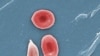Pacientes con células falciformes piden protección contra COVID-19