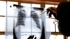 FILE - A doctor examines chest X-rays at a tuberculosis clinic in Gugulethu, Cape Town, South Africa.