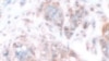 Shared Traits Could Help Scientists Find Cancer Cure