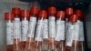 PCR i serološki testovi: mali vodič