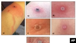 En esta imagen, proporcionada por el Departamento de Salud de Alaska, se muestran varias lesiones provocadas por la viruela de Alaska. (Departamento de Salud de Alaska vía AP)