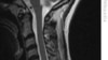 Cancer Drug Improves Movement in Rats with Spine Injury